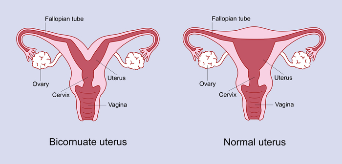 Bicornuate uterus A bicornuate uterus has a deep indentation at the top of the uterus.