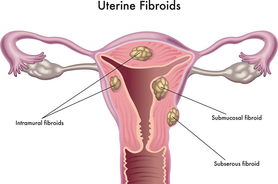 Uterine fibroids Illustration showing the anatomy of the uterus, with 4 different fibroid growths in the uterus and uterus muscle.