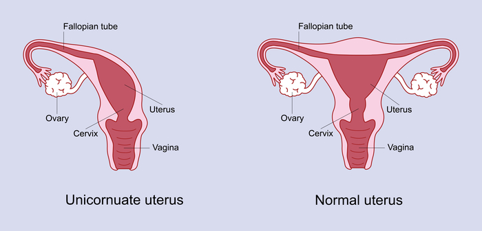 Unicornate uterus A unicornate uterus means that the womb is half the usual size, and occurs because half of the uterus didn’t develop as expected.