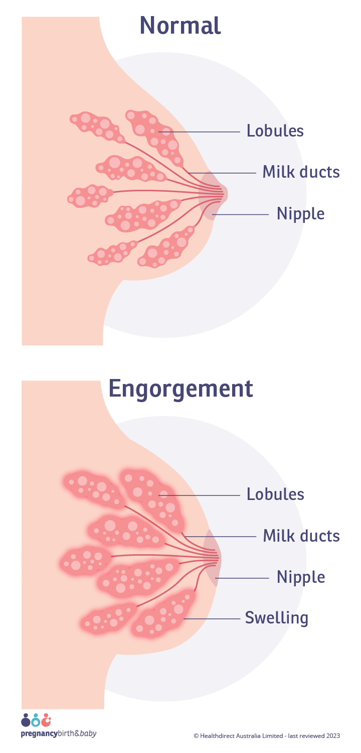Breast engorgement Portrait illustration of a normal breast and lobules, alongside a breast with engorgement and swollen lobules.