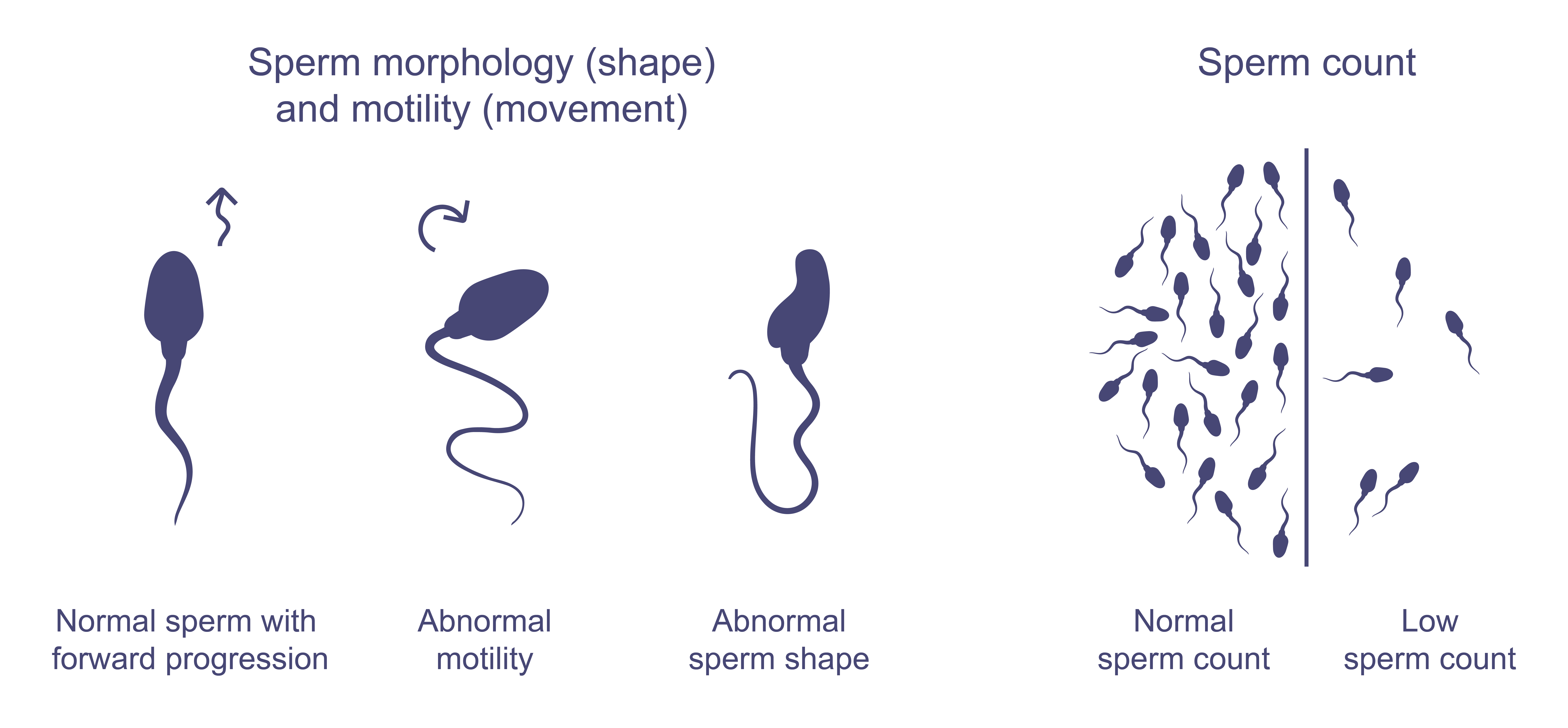 Sperm Health Infographic on sperm health, showing examples of normal sperm movement (forward spiraling like a cork screw) and abnormal movement (zig zagging or circling in on itself), normal sperm shape (oval head with a long tail) and an abnormal shape (head or tail defects). Along with a side by side comparison of normal sperm count (at least 15million sperm per mL) and low sperm count.